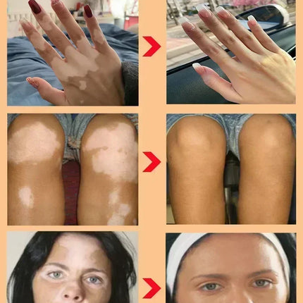 Vitiligo Cream For Vitiligo Sufferers Eelhoe Relief by zapcart