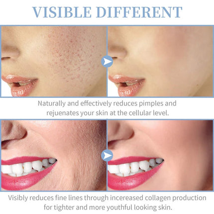 High Frequency Skin Therapy Wand Handheld Acne Rejuvenation by zapcart