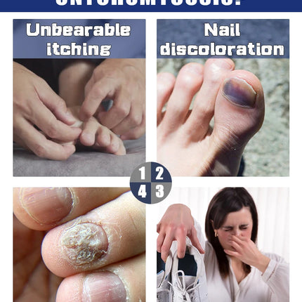 SLIBRIDGE Fungal Nail Repair Fast For Toenail Fungus by zapcart