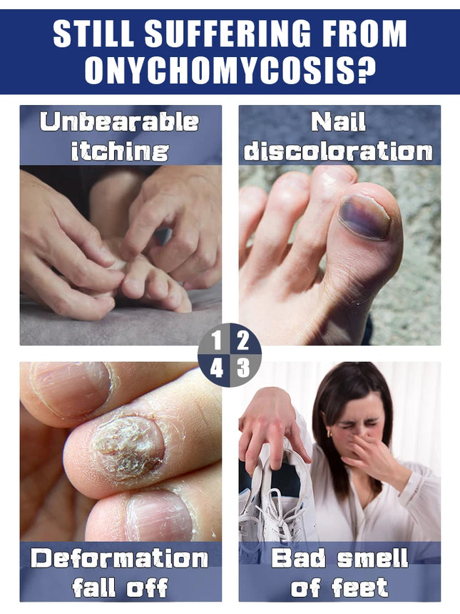 SLIBRIDGE Fungal Nail Repair Fast For Toenail Fungus by zapcart