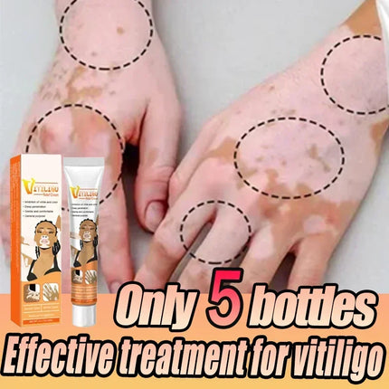 Vitiligo Cream For Vitiligo Sufferers Eelhoe Relief by zapcart