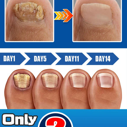 SLIBRIDGE Fungal Nail Repair Fast For Toenail Fungus by zapcart